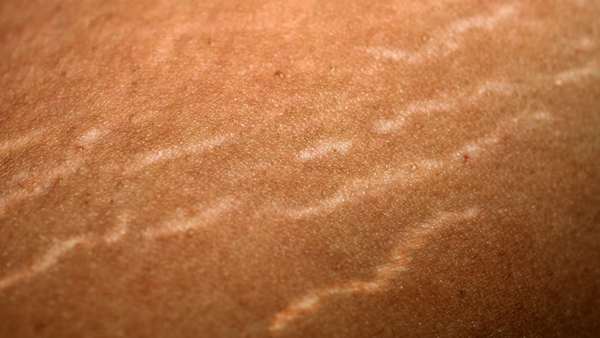 What are stretch marks and can they be camouflaged?